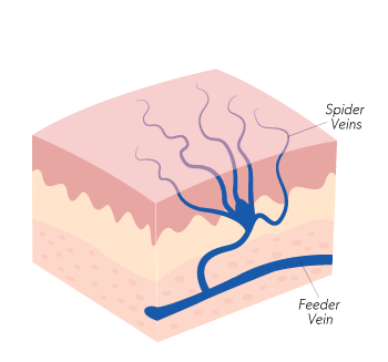 Sclerotherapy-animate